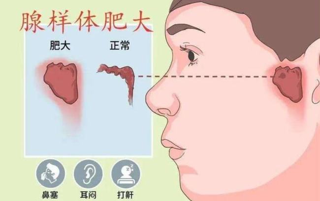 腺樣體肥大能自愈嗎？——深度解析與理解，腺樣體肥大能否自愈？全面深度解析