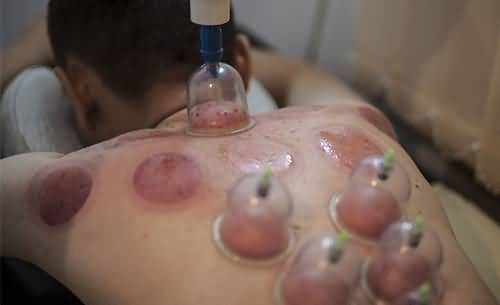 拔罐治療需謹(jǐn)慎，了解拔罐20天死亡的風(fēng)險與正確方法，拔罐治療風(fēng)險警示，了解正確方法與避免20天死亡風(fēng)險