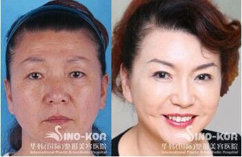美容去皺紋針的價格，了解一針的價格及更多細節(jié)，美容去皺針價格解析，一針的價格及更多細節(jié)揭秘