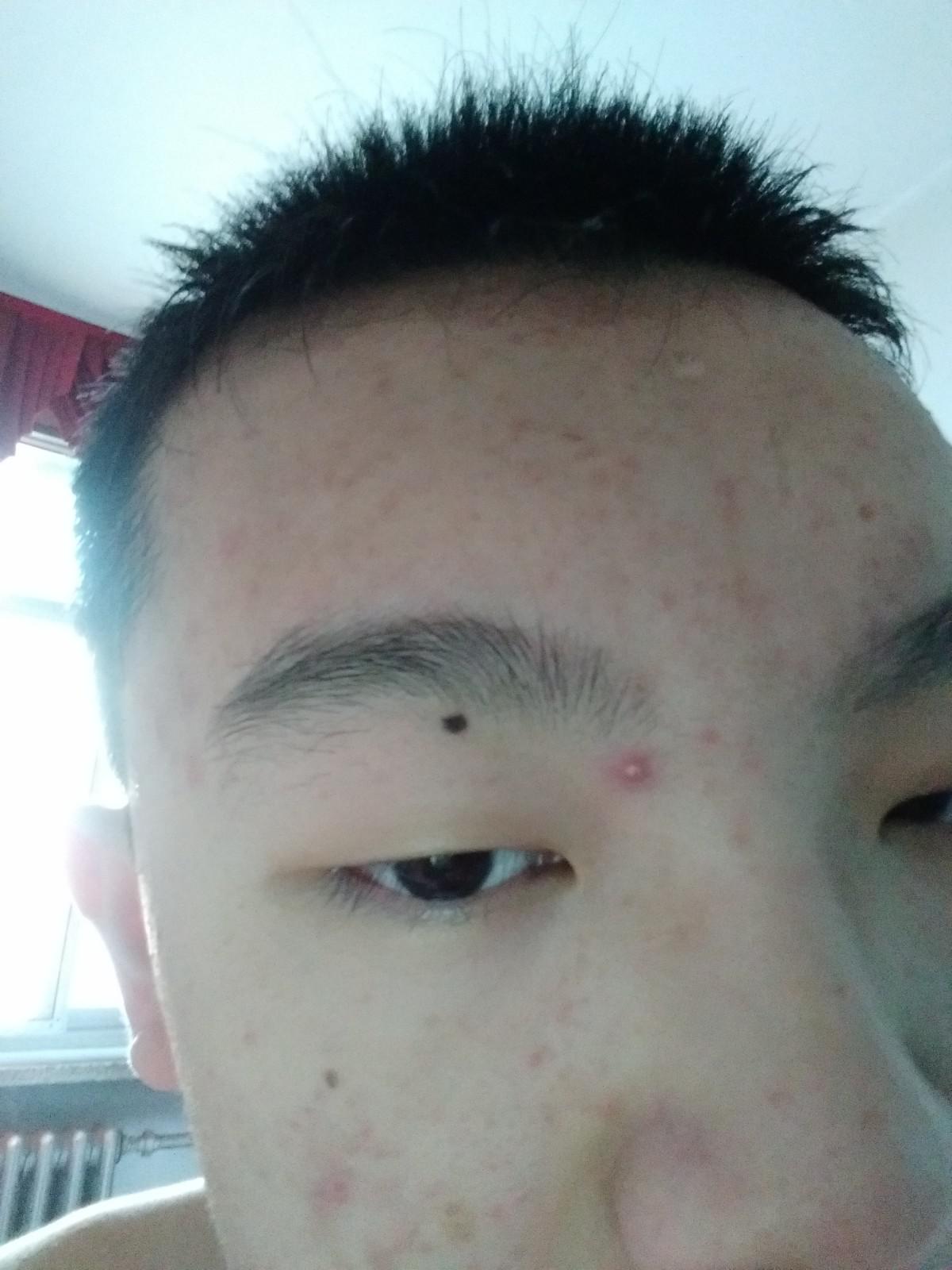 臉上痘痘太多了怎么辦？全方位護膚指南助你擺脫困擾，全方位護膚指南，解決臉部痘痘困擾，重拾肌膚光彩