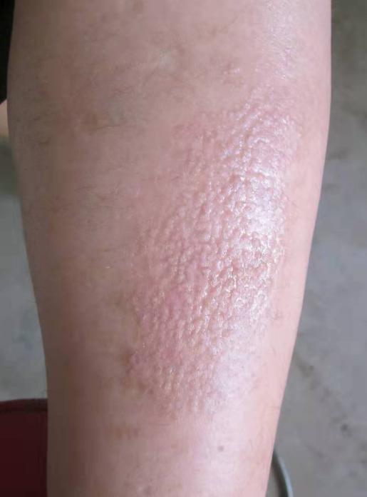 無緣無故長疙瘩又紅又癢，原因解析與應(yīng)對策略，無緣無故長紅癢疙瘩，原因解析及應(yīng)對方法