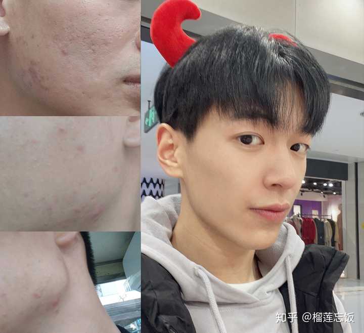 如何有效去除臉上的痘印——全方位指南，全方位指南，如何有效去除臉上痘印的方法