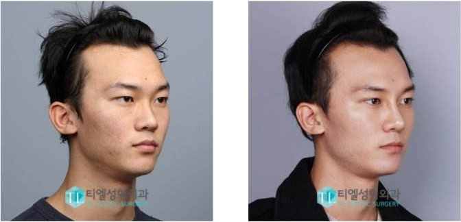 男士整容前后圖片，探索變化，揭示真實(shí)，男士整容前后對比，探索變化，揭示真實(shí)之美